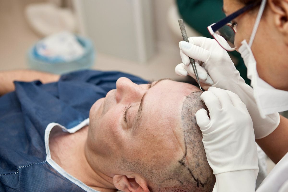 Best Hair Transplant Clinics in Spain